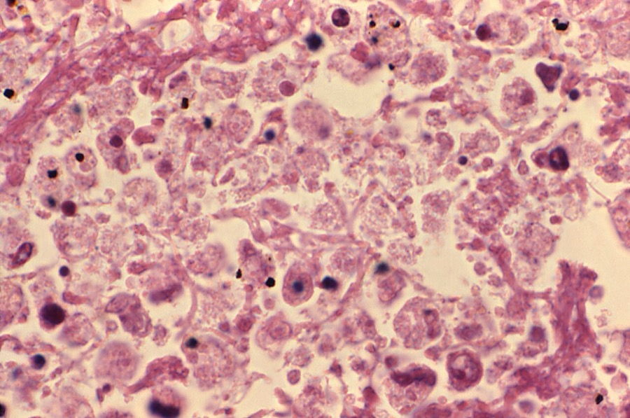 Tumour histopathology